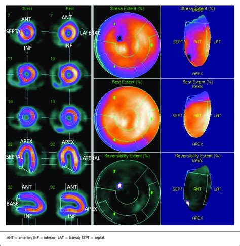 is a nuclear stress test hard on the kidneys|Nuclear stress test Information .